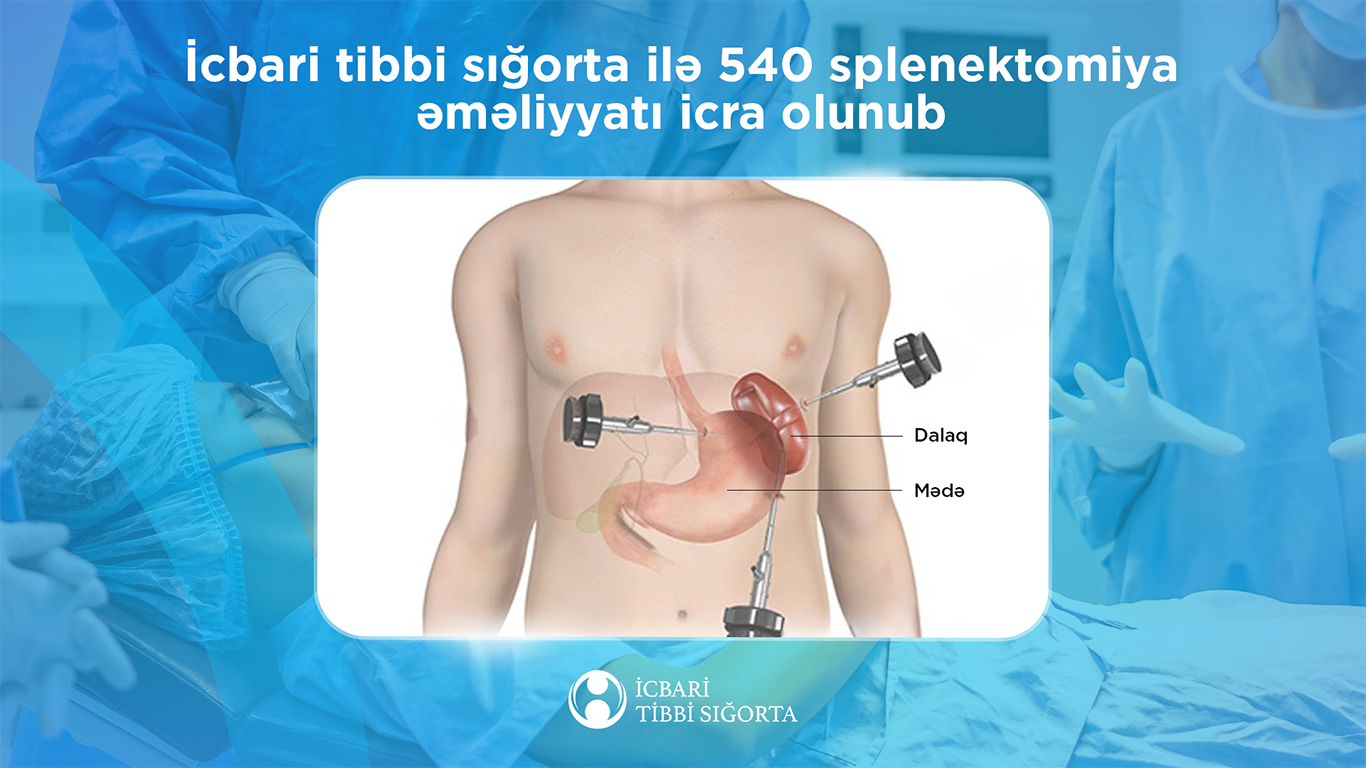 İcbari tibbi sığorta ilə 540 splenektomiya əməliyyatı icra olunub