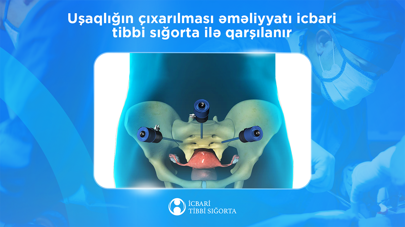 İcbari tibbi sığorta uşaqlığın çıxarılması əməliyyatını qarşılayır