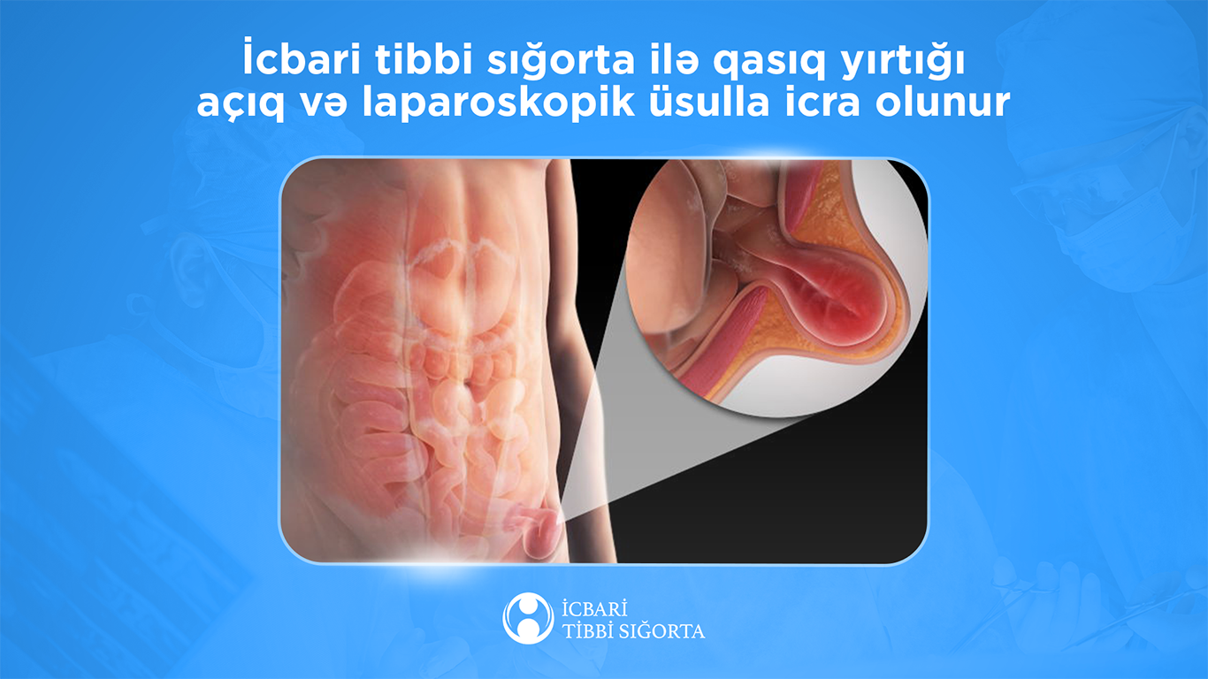 İcbari tibbi sığorta ilə qasıq yırtığı açıq və laparoskopik üsulla icra olunur
