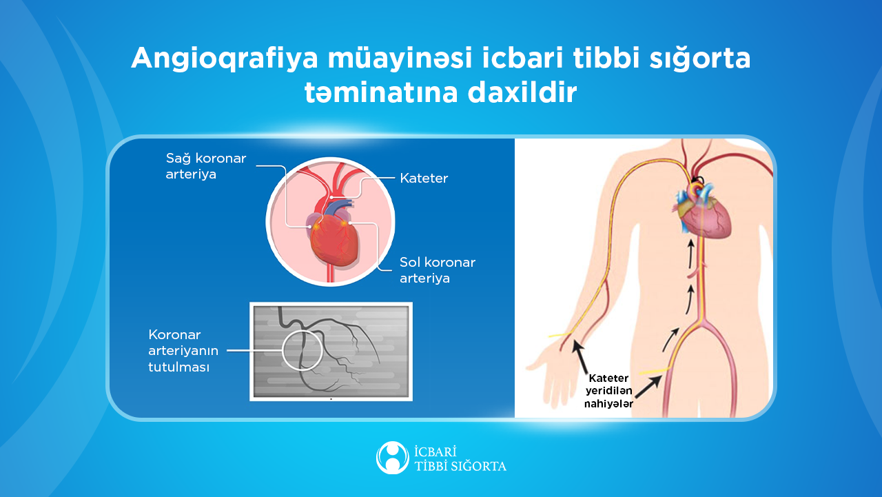 İcbari tibbi sığorta ilə 50 mindən artıq angioqrafiya müayinəsi aparılıb