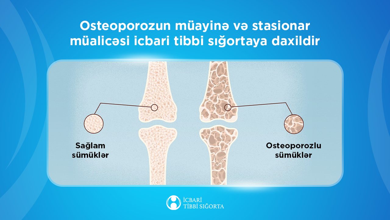 Osteoporozun müayinə və stasionar müalicəsi icbari tibbi sığortaya daxildir
